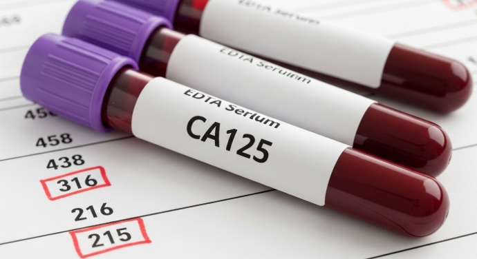 卵巢癌檢查推薦｜CA125 指數＋婦科超聲波全攻略｜香港卵巢癌早期檢查建議